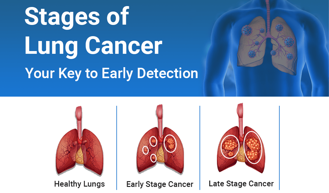 stages of lung cancer