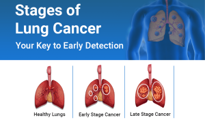 Stages of Lung Cancer: Your Key to Early Detection